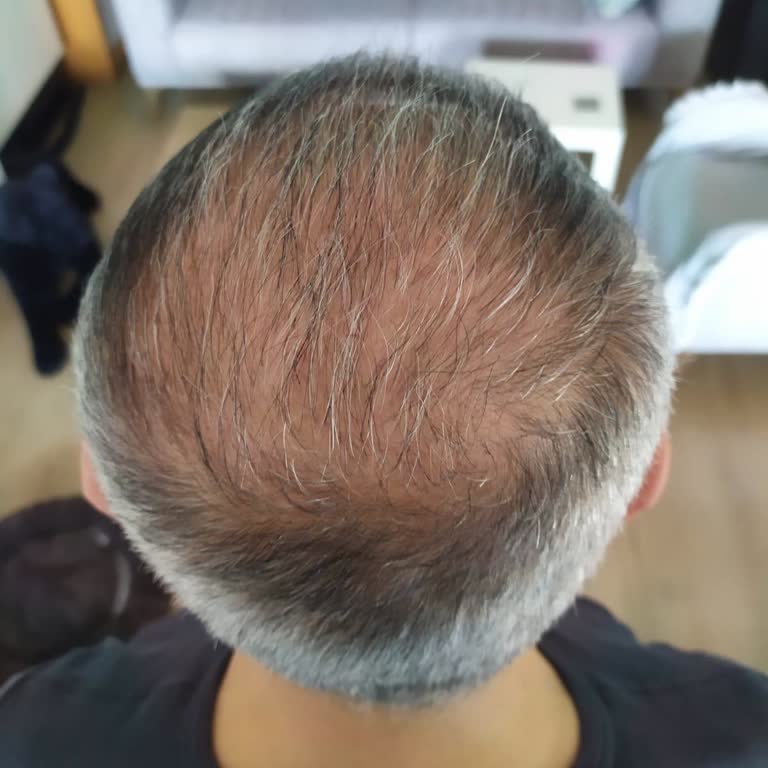 Saç Ekimi Garantisi ve Şikayet