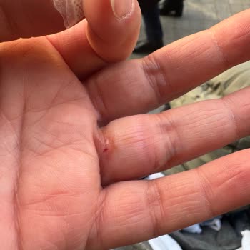 Parlatma İşlemi Sonrası Kırılan Yüzükte Garanti İhlali