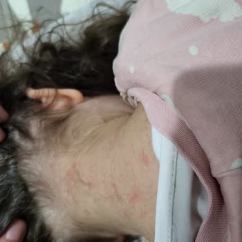 Uni Baby Kolay Tarama Spreyi Çocuğumda Ciddi Alerjik Reaksiyon