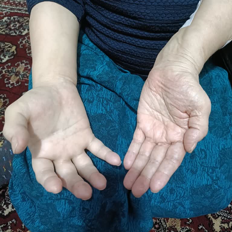 Tomografi Bölümünde Tek Başına Çalışan Hemşirenin Duyarsız Tutumu Ve Kol Şişliğine Yetersiz Müdahale