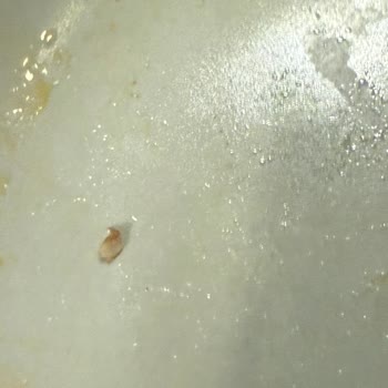 Migros Uzman Kasap Hamburger Köftesinde Kemik Parçası Çıktı, Diş Dolgusu Ağrıya Sebep Oldu