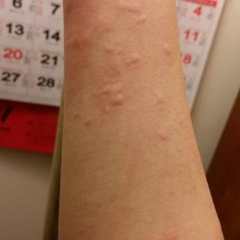 Eti Tutku Bisküvisi Ve Çubuk Krakerinde Şiddetli Kabarma Ve Yanma Şikayeti