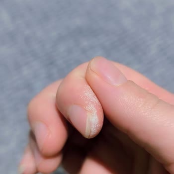 Koleston 09 Sarı’da Cilt Yanması Ve Boya Etkisizliği