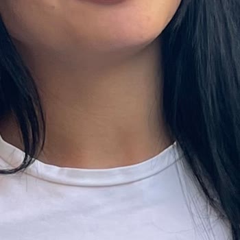 The W Aesthetic Dudak Dolgusunda Simetri Bozukluğu