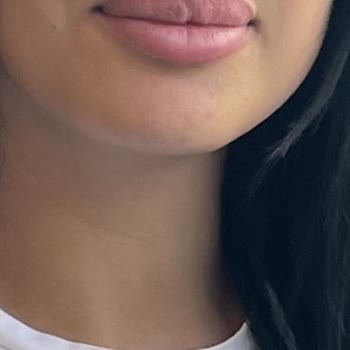 The W Aesthetic Dudak Dolgusunda Simetri Bozukluğu