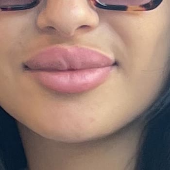 The W Aesthetic Dudak Dolgusunda Simetri Bozukluğu