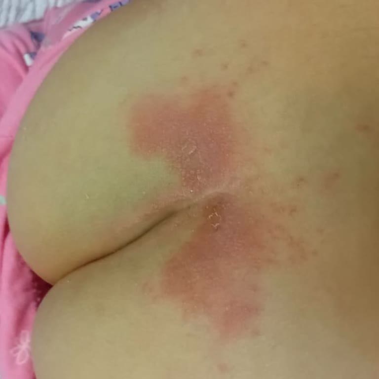 Kampanyalı Bebek Bezi Kullanımından Sonra Bebeğimde Şiddetli Cilt Tahrişi