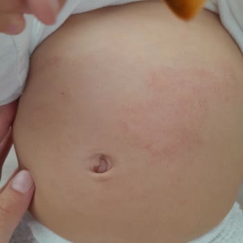 Dalin Bebekte Kızarıklık Ve Kabarıklık Nedeniyle Ürün İade Talebi!