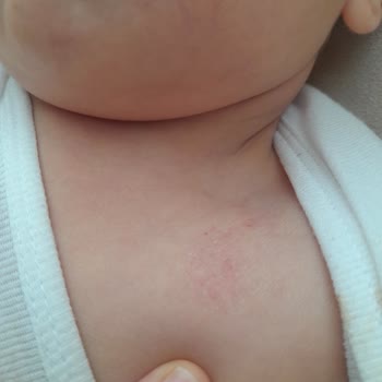 Dalin Bebekte Kızarıklık Ve Kabarıklık Nedeniyle Ürün İade Talebi!