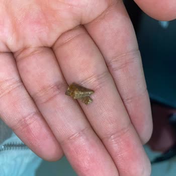 Banvit Köfte İçindeki Taş Diş Ve Ağız Sağlığını Tehlikeye Atıyor!