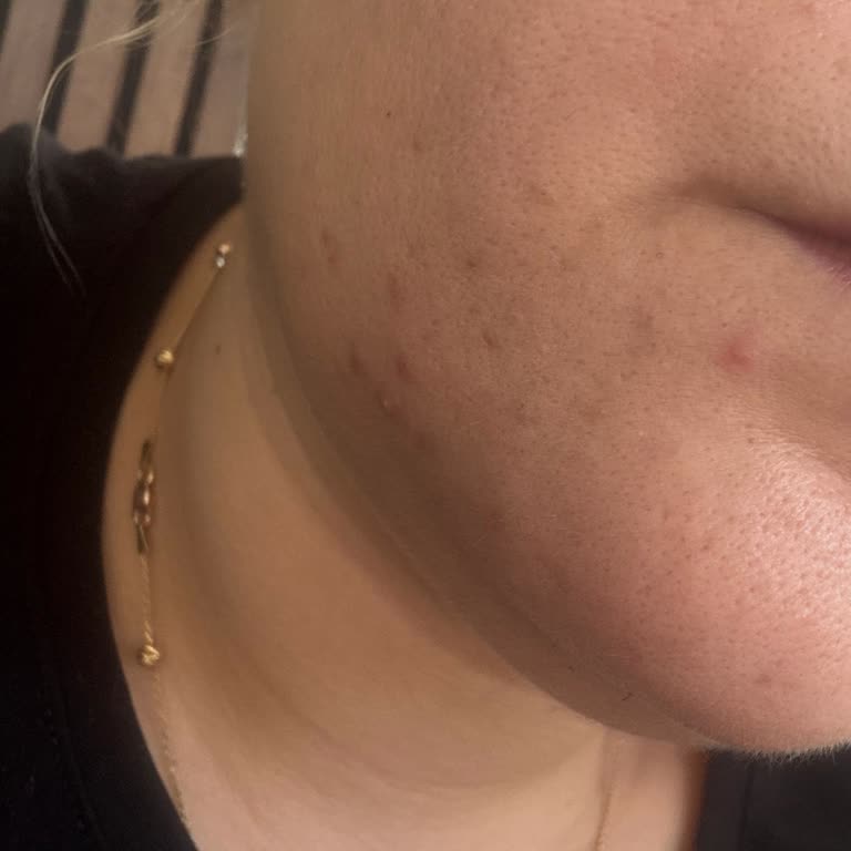 Effaclar Ürünleri Cildimde Şiddetli İltihap Ve Sivilcelere Neden Oldu