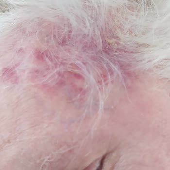 Avrasya Hospital Yoğun Bakımda Açıklanamayan Alın Morluğu Ve Şiddetli Bacak Ödemi