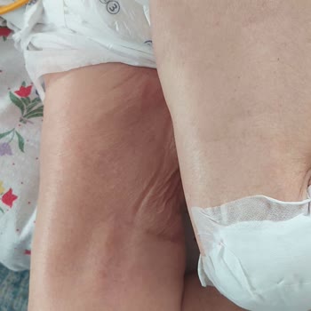 Avrasya Hospital Yoğun Bakımda Açıklanamayan Alın Morluğu Ve Şiddetli Bacak Ödemi