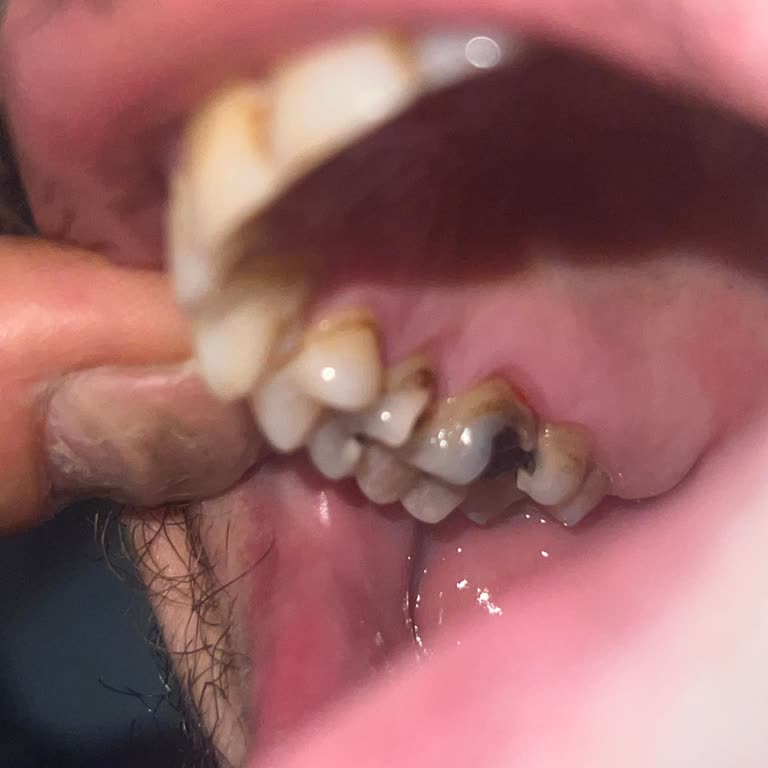 Sert Fındık Nedeniyle Dişim Kırıldı Ve Tazmin Talep Ediyorum