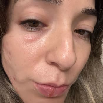 Caudalie Ürünleri Kullanım Sonrası Şiddetli Cilt Reaksiyonları Ve Ücret İadesi Talebi