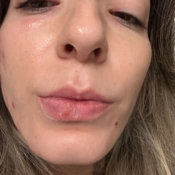 Caudalie Ürünleri Kullanım Sonrası Şiddetli Cilt Reaksiyonları Ve Ücret İadesi Talebi