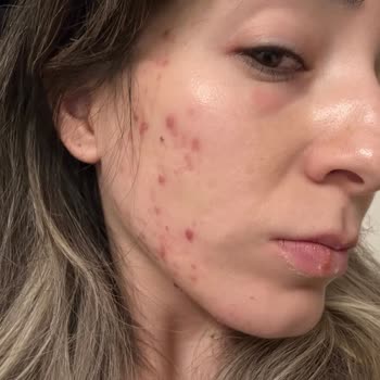 Caudalie Ürünleri Kullanım Sonrası Şiddetli Cilt Reaksiyonları Ve Ücret İadesi Talebi