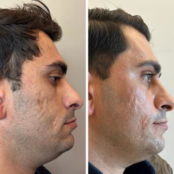 118.000 TL'lik Dermatoloji Tedavisinde Sonuç Yok, İade Talebi