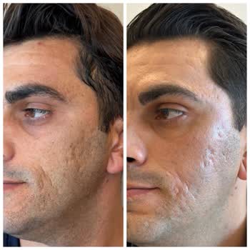 118.000 TL'lik Dermatoloji Tedavisinde Sonuç Yok, İade Talebi