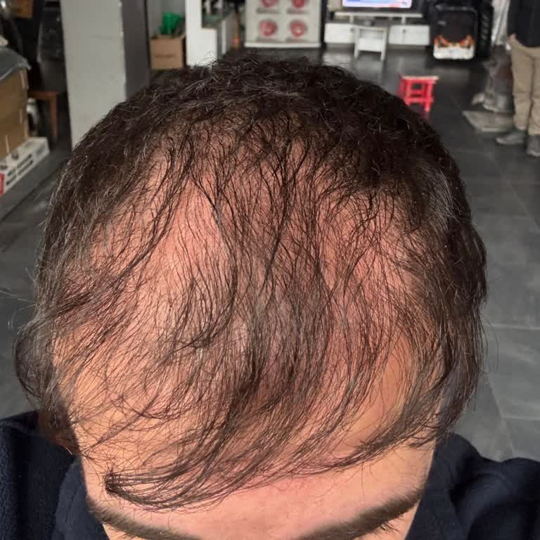 Altınsoy Saç Ekim’de Kalıcı İzler Ve Seyrekleşme Nedeniyle Ücret İadesi Talebi