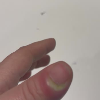 Hijyen Eksikliği Nedeniyle Tırnak Uygulamasında Enfeksiyon Ve Hastane Süreci