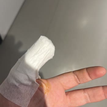 Hijyen Eksikliği Nedeniyle Tırnak Uygulamasında Enfeksiyon Ve Hastane Süreci