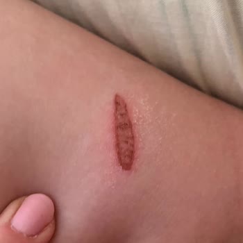 Lazer Epilasyon Yanığı Ve Salonun Cevapsız Tutumu