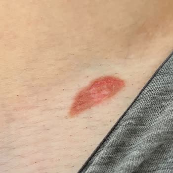 Lazer Epilasyon Yanığı Ve Salonun Cevapsız Tutumu