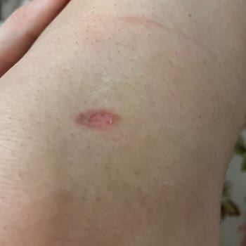 Lazer Epilasyon Yanığı Ve Salonun Cevapsız Tutumu