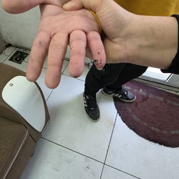 Patlayan Çakmak Yanık Ve Yangın Tehdidi