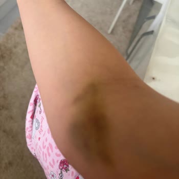 Yanlış Kan Alımı Ve Kaba Personel Davranışı