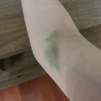 Yanlış Kan Alımı Ve Kaba Personel Davranışı