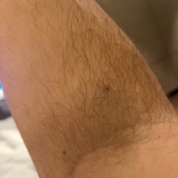 Memorial Hastanesinde Hemşire İhmali Ve 8 Kez Damar Yolu Açma Denemesi