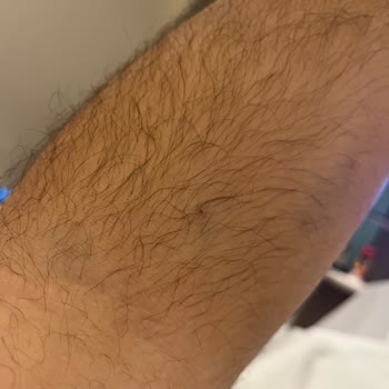 Memorial Hastanesinde Hemşire İhmali Ve 8 Kez Damar Yolu Açma Denemesi