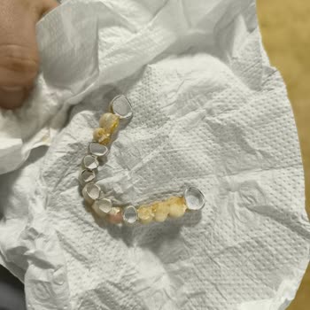 Protez Dişte Oluşan Apse Ve Şiddetli Ağrı Şikayeti