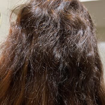 Saç Kaynağında 22.000 TL'lik Hatalı İşlem, Ağrı, Saç Kaybı Ve İade Talebi