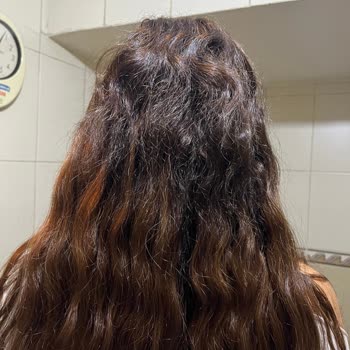 Saç Kaynağında 22.000 TL'lik Hatalı İşlem, Ağrı, Saç Kaybı Ve İade Talebi