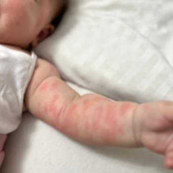 Mustela Baby Products Caused Severe Eczema and Allergic Reactions