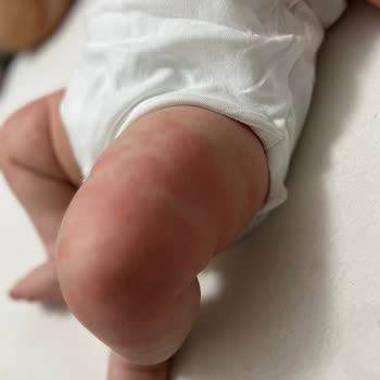 Mustela Baby Products Caused Severe Eczema and Allergic Reactions