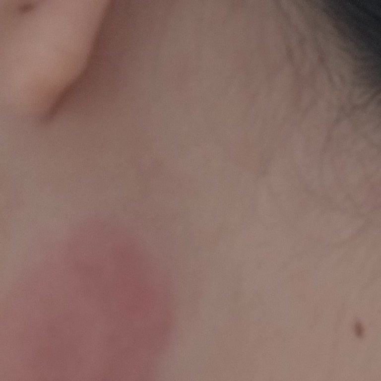 Doğal Losyon Kullanımından Şiddetli Alerji Ve Kalıcı İzler