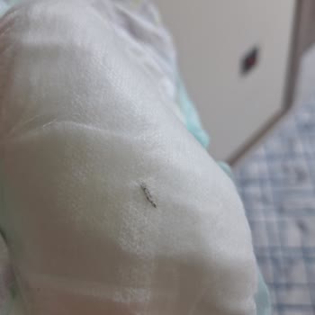 Tekrarlanan Hijyen Sorunu Bebek Bezinde Yabancı Cisim