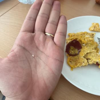 Maret Sucuğunda Yabancı Madde Diş Kırılmasına Neden Oldu