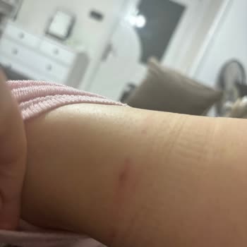 Deichmann Botunda Renk Soyulması Ve Ayak Bileği Kesilmesi, Mağaza Cevapsızlığı