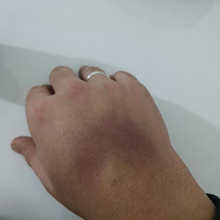 Life Hastanesi'nde Kan Alımında Damar Patlaması Ve Şiddetli Morluk