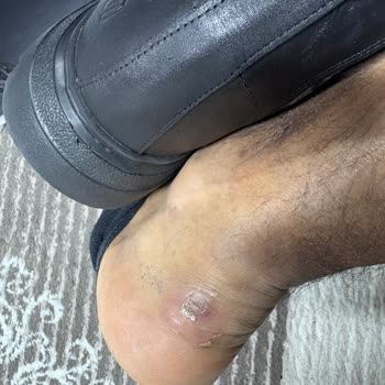 Sol Ayakta Baskı Nedeniyle Derimod Botta Ağrı Ve İade Reddi