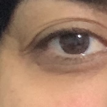 Neutrogena Yüz Yıkama Jelinde Göz Çevresinde Şiddetli Yanma Ve Beyaz İzler