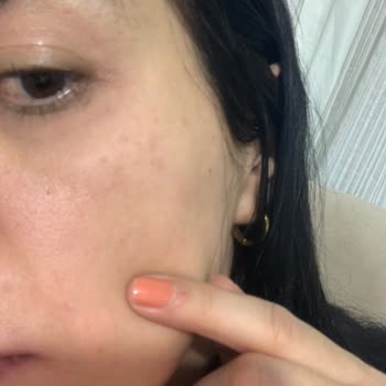 Neutrogena Yüz Yıkama Jelinde Göz Çevresinde Şiddetli Yanma Ve Beyaz İzler