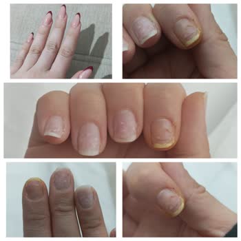 Valeria Beauty Hijyenik Olmayan Salon Ve Kalitesiz Protez Tırnak Nedeniyle Enfeksiyon