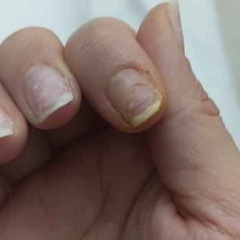 Valeria Beauty Hijyenik Olmayan Salon Ve Kalitesiz Protez Tırnak Nedeniyle Enfeksiyon