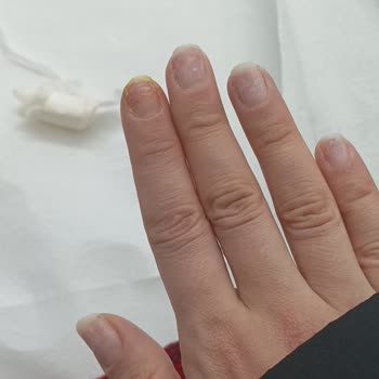 Valeria Beauty Hijyenik Olmayan Salon Ve Kalitesiz Protez Tırnak Nedeniyle Enfeksiyon